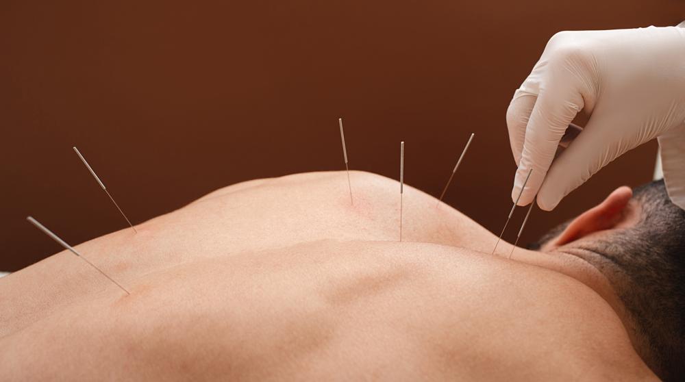accuponcture